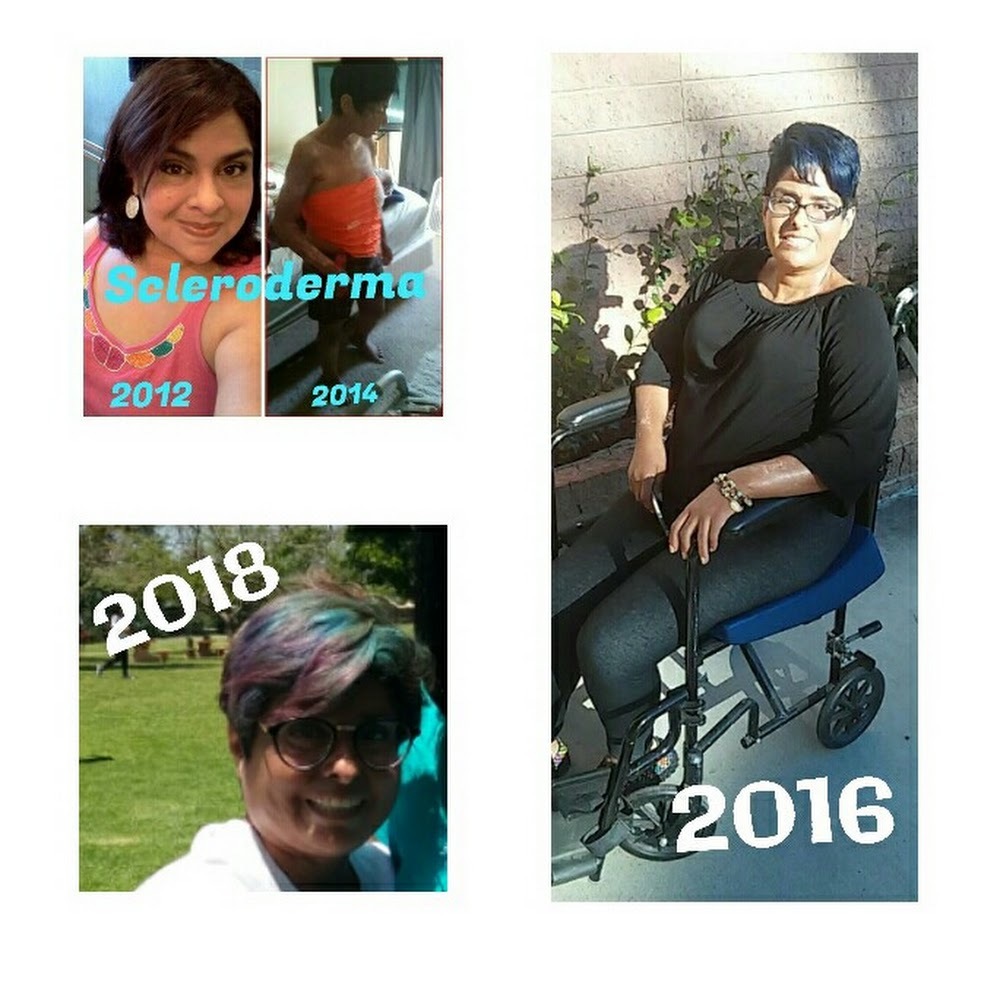 Meet your Posher, Scleroderma